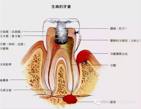 根管測(cè)量受影響的原因