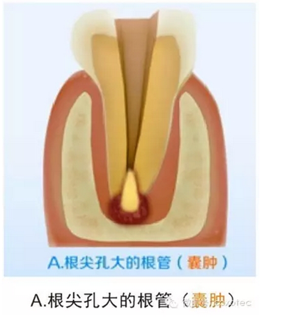 讓你知道根管測(cè)量受影響的原因