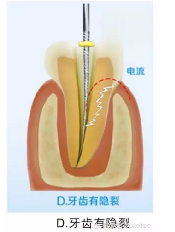 讓你知道根管測(cè)量受影響的原因