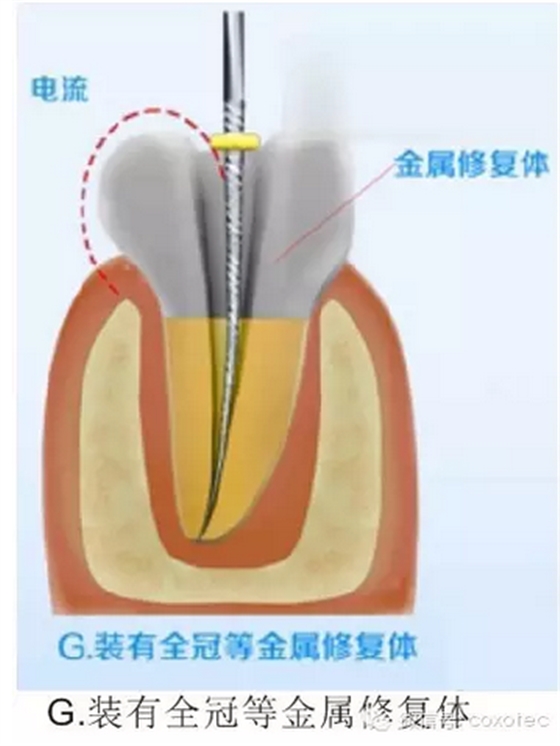 讓你知道根管測(cè)量受影響的原因