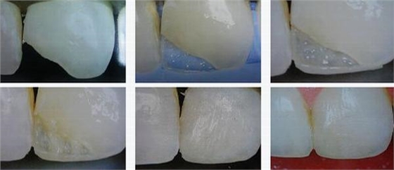 各類牙洞型樹脂修復(fù)