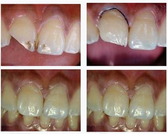 各類牙洞型樹脂修復(fù)