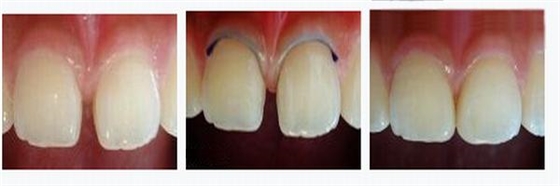 各類牙洞型樹脂修復(fù)