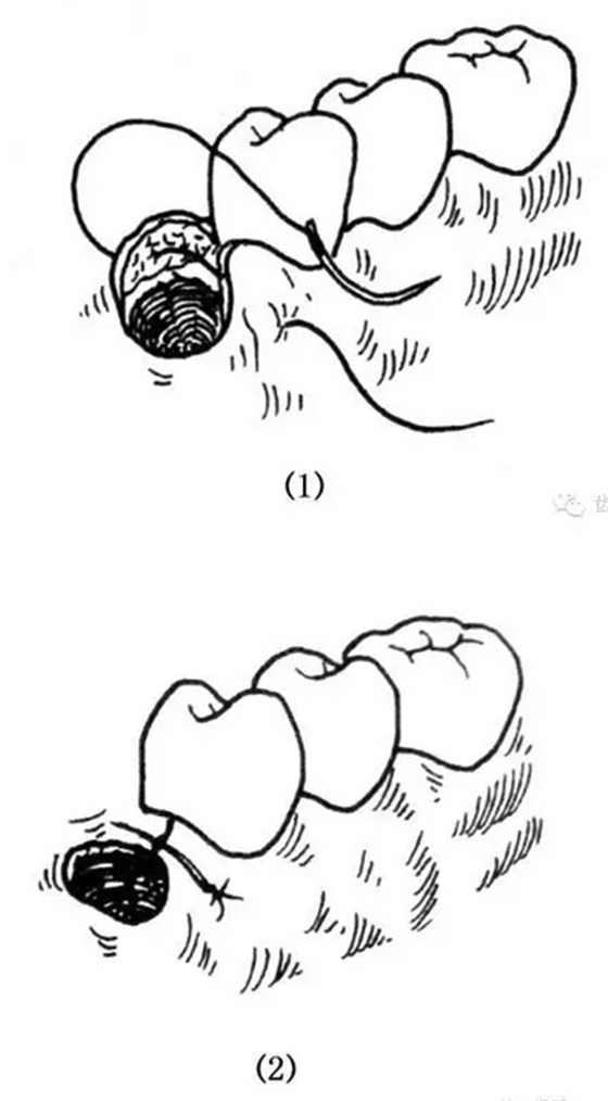 牙醫(yī)基本技能：口內(nèi)縫合術(shù)（文字、示意圖及視頻）