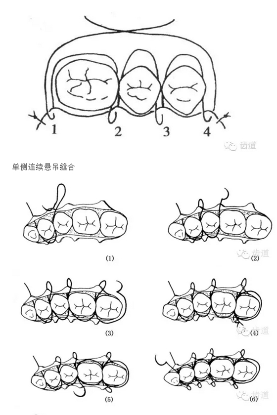 牙醫(yī)基本技能：口內(nèi)縫合術(shù)（文字、示意圖及視頻）