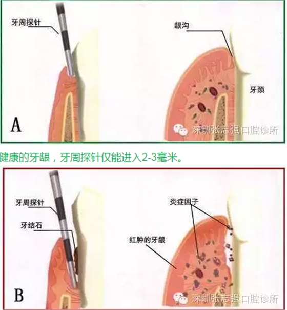 刷牙出血，牙齦紅腫，并非缺乏維生素