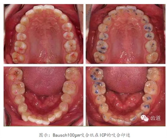 牙科咬合紙的用法