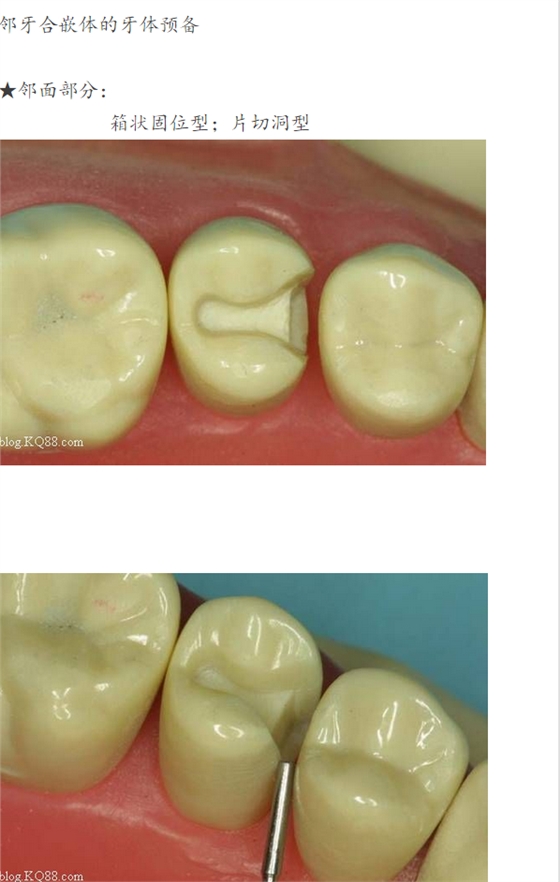 嵌體牙體預備方法