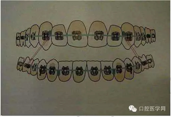 正畸damon system橡皮筋(elastics)掛法示意圖