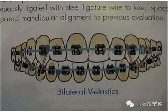 正畸damon system橡皮筋(elastics)掛法示意圖