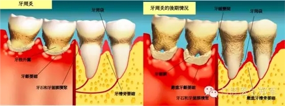 牙周炎的相關(guān)修復(fù)治療原則