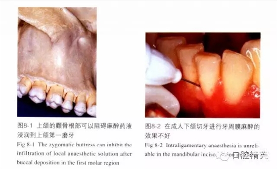 分析局部麻醉失敗的常見(jiàn)原因