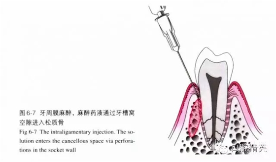 分析局部麻醉失敗的常見(jiàn)原因