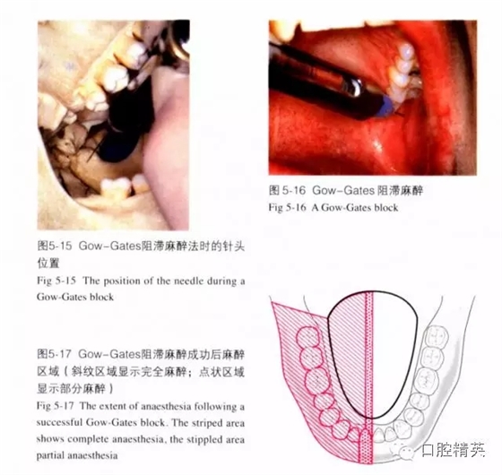 分析局部麻醉失敗的常見(jiàn)原因