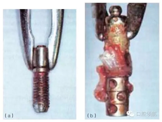 種植體失敗的病因和危險(xiǎn)因素