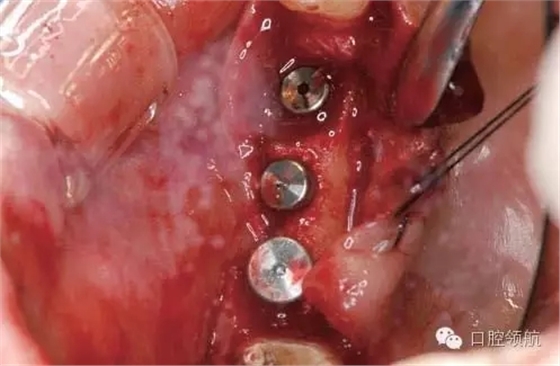 兩次手術法植入植體后數(shù)天，覆蓋螺絲暴露