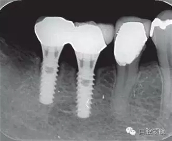 種植體周圍出現(xiàn)伴有骨密度增加現(xiàn)象的骨吸收