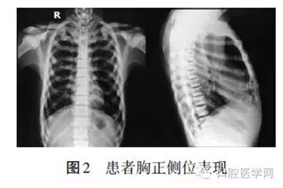 頜骨骨髓炎X線影像