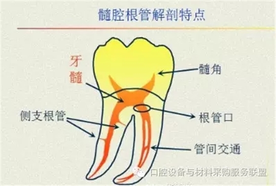 超實(shí)用的根管口的探查術(shù)