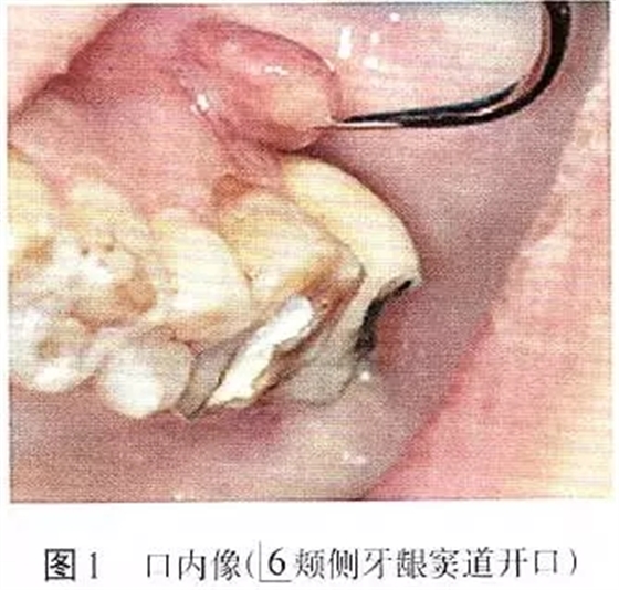 根管治療