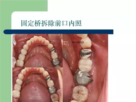 左下后牙不良修復(fù)體拆除后重新修復(fù)一例