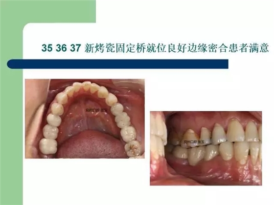 左下后牙不良修復(fù)體拆除后重新修復(fù)一例