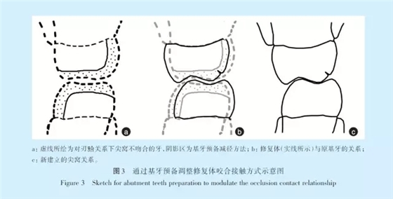 王美青.淺談咬合修復(fù)重建中的（牙合）學(xué)問題