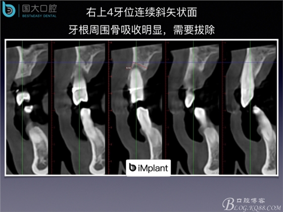 上頜竇底區(qū)域嚴(yán)重骨吸收的臨床種植案例.jpeg