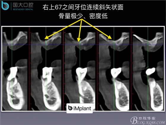 上頜竇底區(qū)域嚴(yán)重骨吸收的臨床種植案例.jpeg