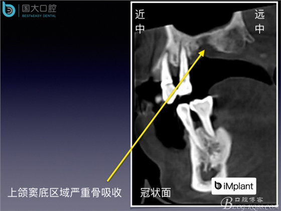 上頜竇底區(qū)域嚴(yán)重骨吸收的臨床種植案例.jpeg