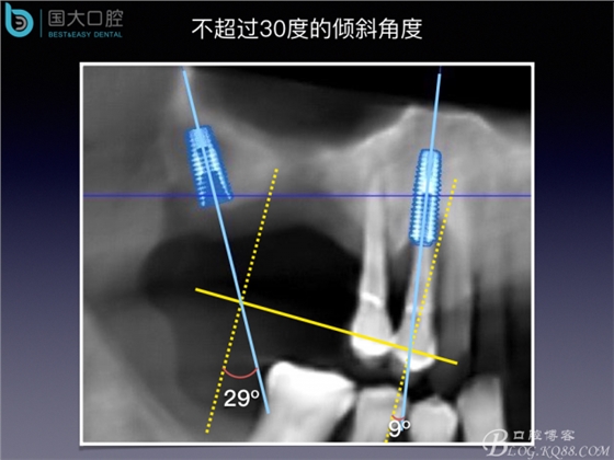 上頜竇底區(qū)域嚴(yán)重骨吸收的臨床種植案例.jpeg