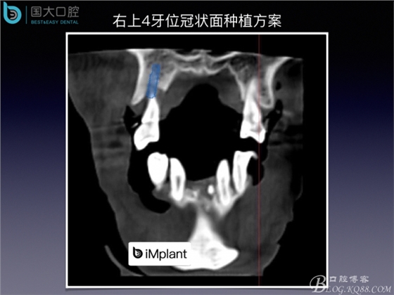 上頜竇底區(qū)域嚴(yán)重骨吸收的臨床種植案例.jpeg