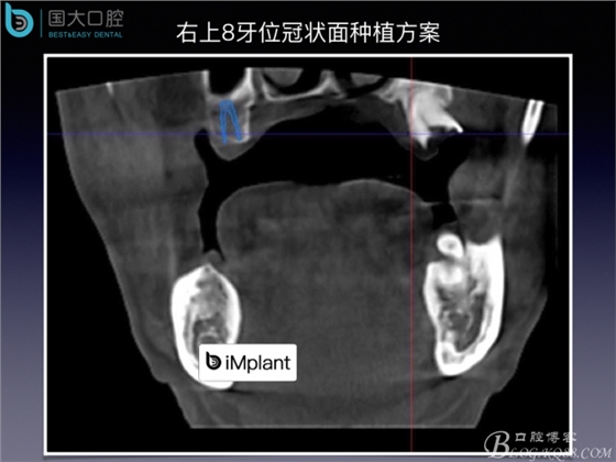 上頜竇底區(qū)域嚴(yán)重骨吸收的臨床種植案例.jpeg