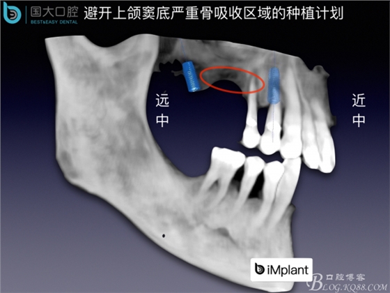 上頜竇底區(qū)域嚴(yán)重骨吸收的臨床種植案例.jpeg