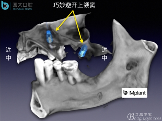 上頜竇底區(qū)域嚴(yán)重骨吸收的臨床種植案例.jpeg