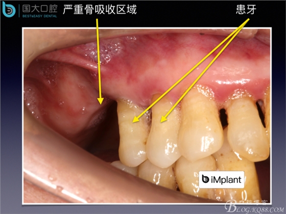 上頜竇底區(qū)域嚴(yán)重骨吸收的臨床種植案例.jpeg