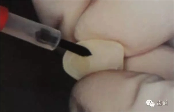瓷貼面的粘接步驟及技術要點
