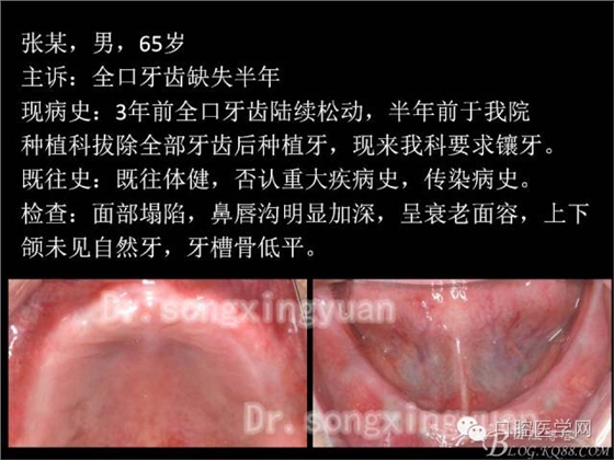 種植牙全口咬合重建