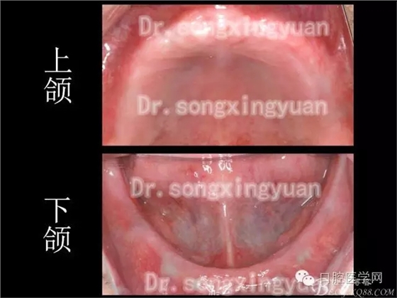 種植牙全口咬合重建