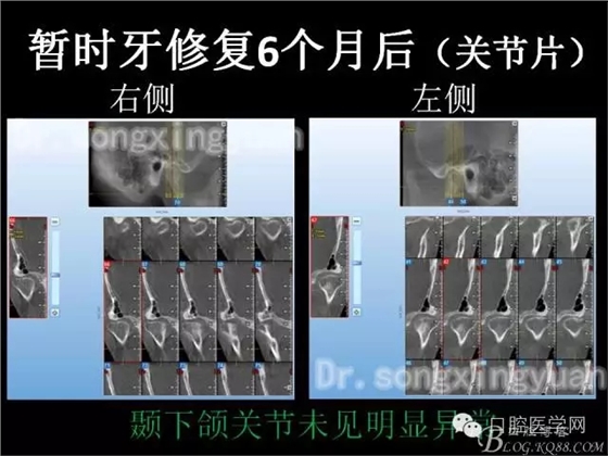 種植牙全口咬合重建