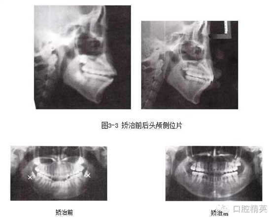 拔牙矯治開(kāi)頜伴前突