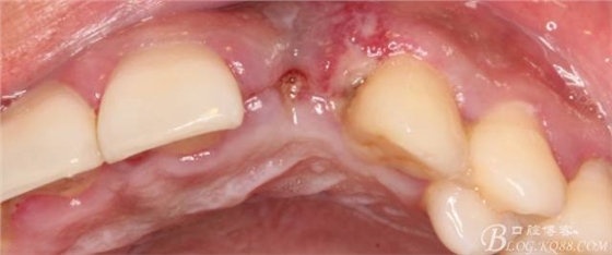 【征文大賽】一例上前牙種植失敗病例的補救--梁光強(qiáng)