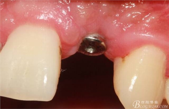 【征文大賽】一例上前牙種植失敗病例的補救--梁光強(qiáng)