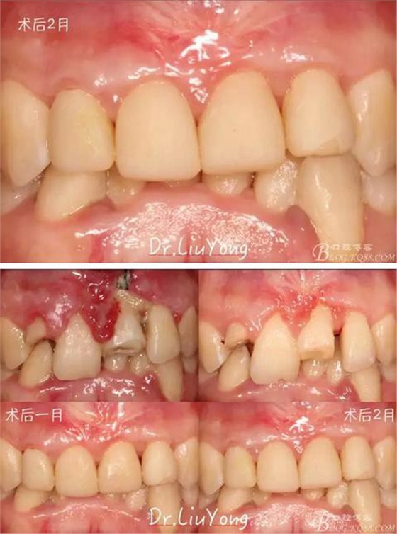 山西牙周劉勇：“前牙外傷患者的口腔多學(xué)科聯(lián)合治療”精彩案例分享