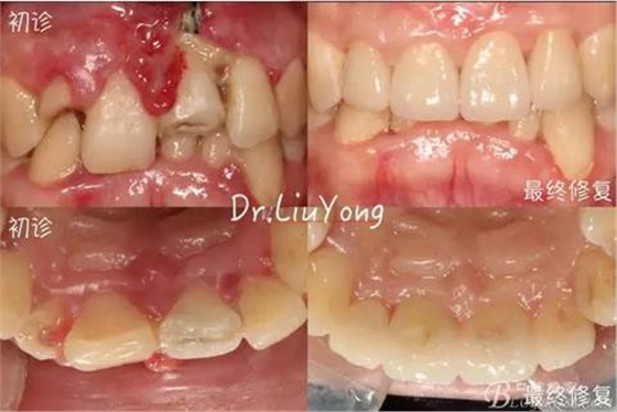 山西牙周劉勇：“前牙外傷患者的口腔多學(xué)科聯(lián)合治療”精彩案例分享