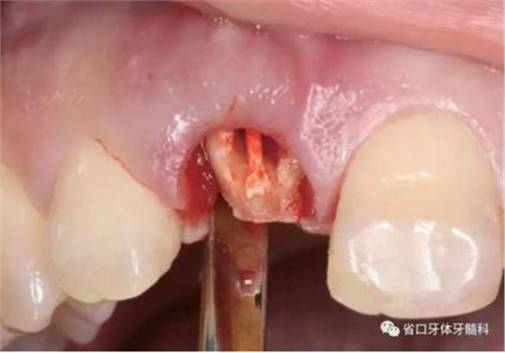 右上前牙即刻種植即刻修復(fù)1例
