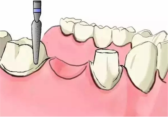 圖解：種牙與鑲牙的區(qū)別，缺牙的趕緊看.png