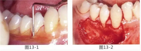 FGG法增大附著齦及根面覆蓋【牙齦－牙槽黏膜的問題】