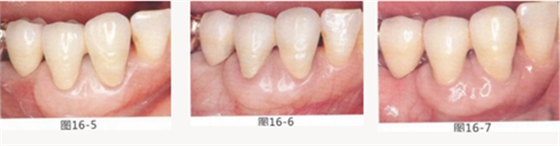 FGG法增大附著齦及根面覆蓋【牙齦－牙槽黏膜的問題】