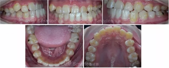 【病例展示】Smartee隱形正畸中國好病例鑒賞第三波
